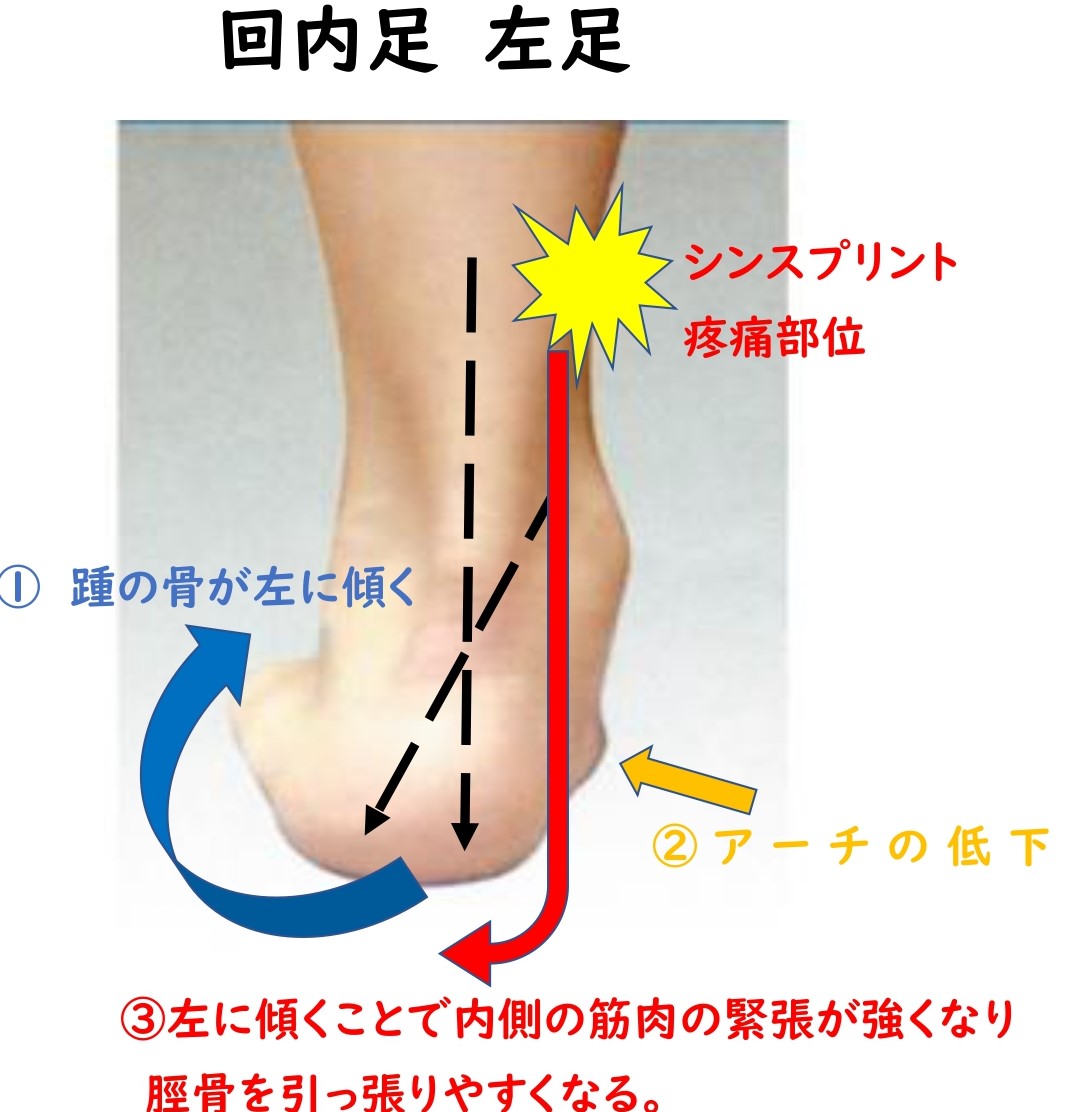 シンスプリントについて まちの整骨院グループ