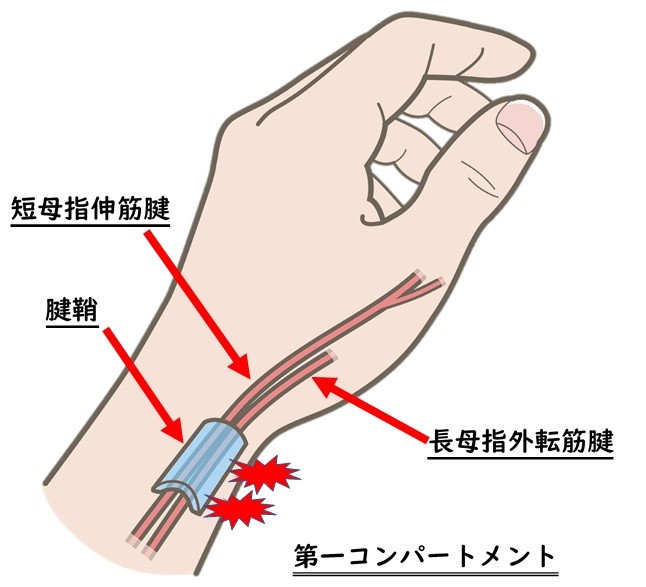 狭窄性腱鞘炎（ドゲルバン病）について | まちの整骨院グループ