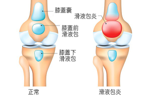 滑液包炎